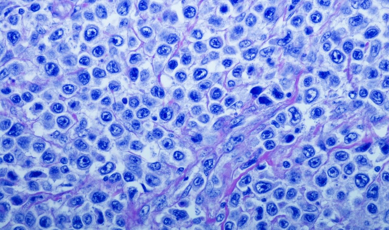 Diffuses großzelliges B-Zell-Lymphom (DLBCL)